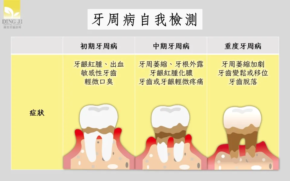 一分鐘了解牙周病的原因！擊退牙周病看這裡！｜鼎吉牙醫診所