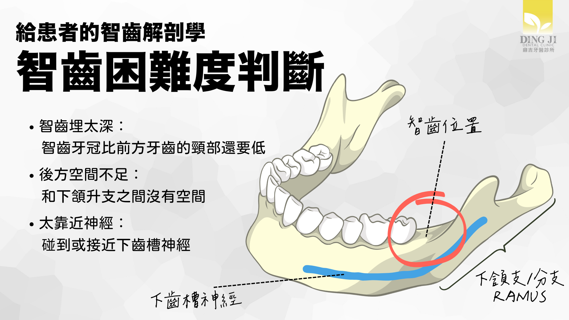 智齒構造困難度判斷