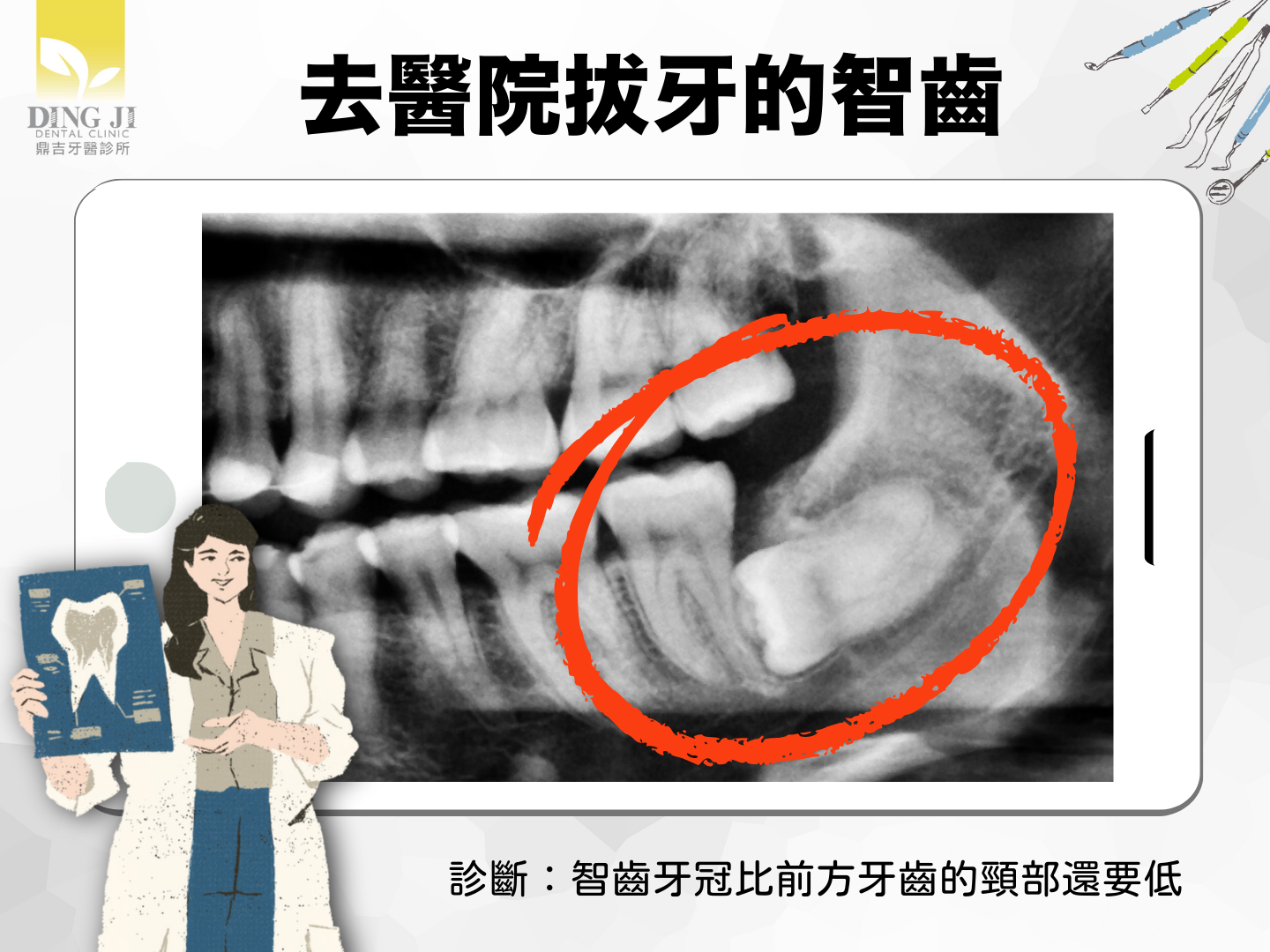 智齒太深困難智齒
