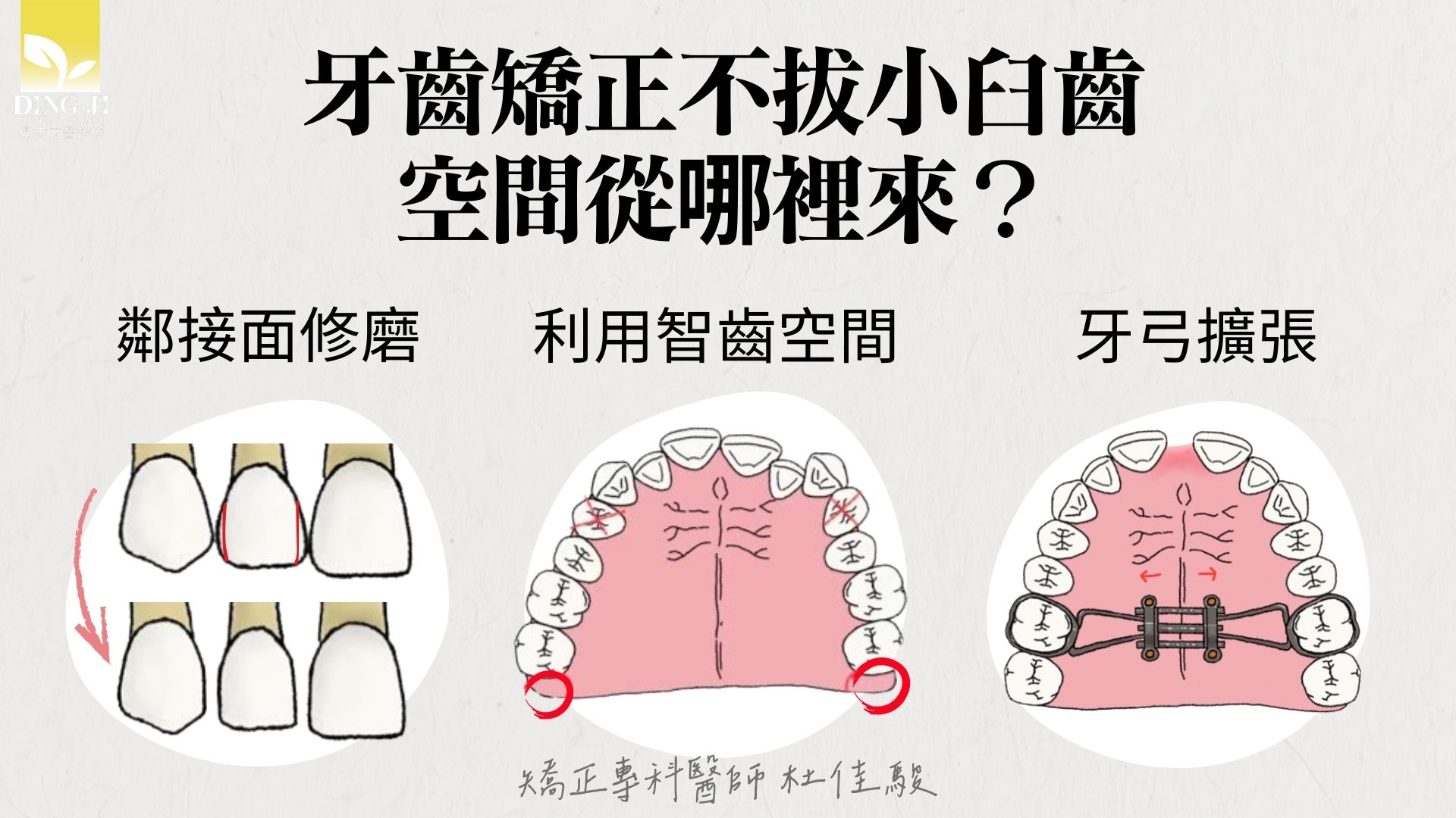 牙齒矯正不拔牙齒的方法