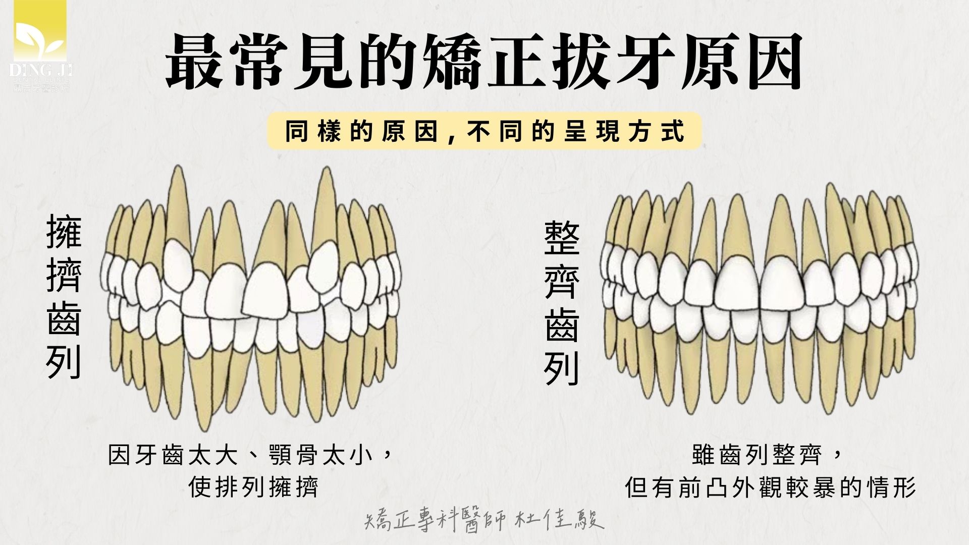 矯正拔牙的原因
