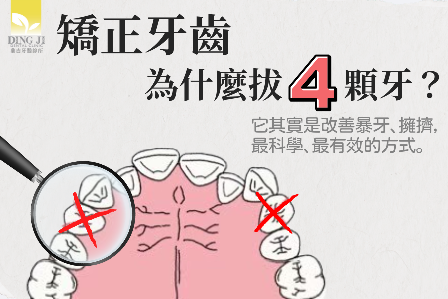 矯正牙齒為什麼拔四顆小臼齒