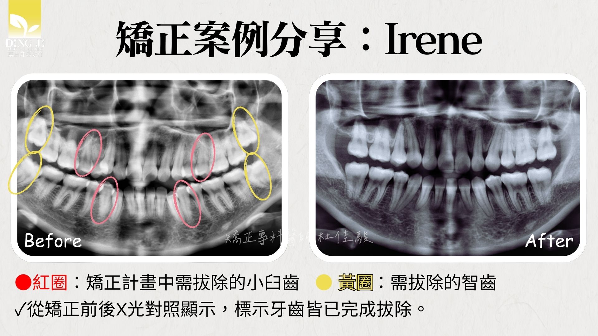 牙齒矯正拔四顆牙成果分享