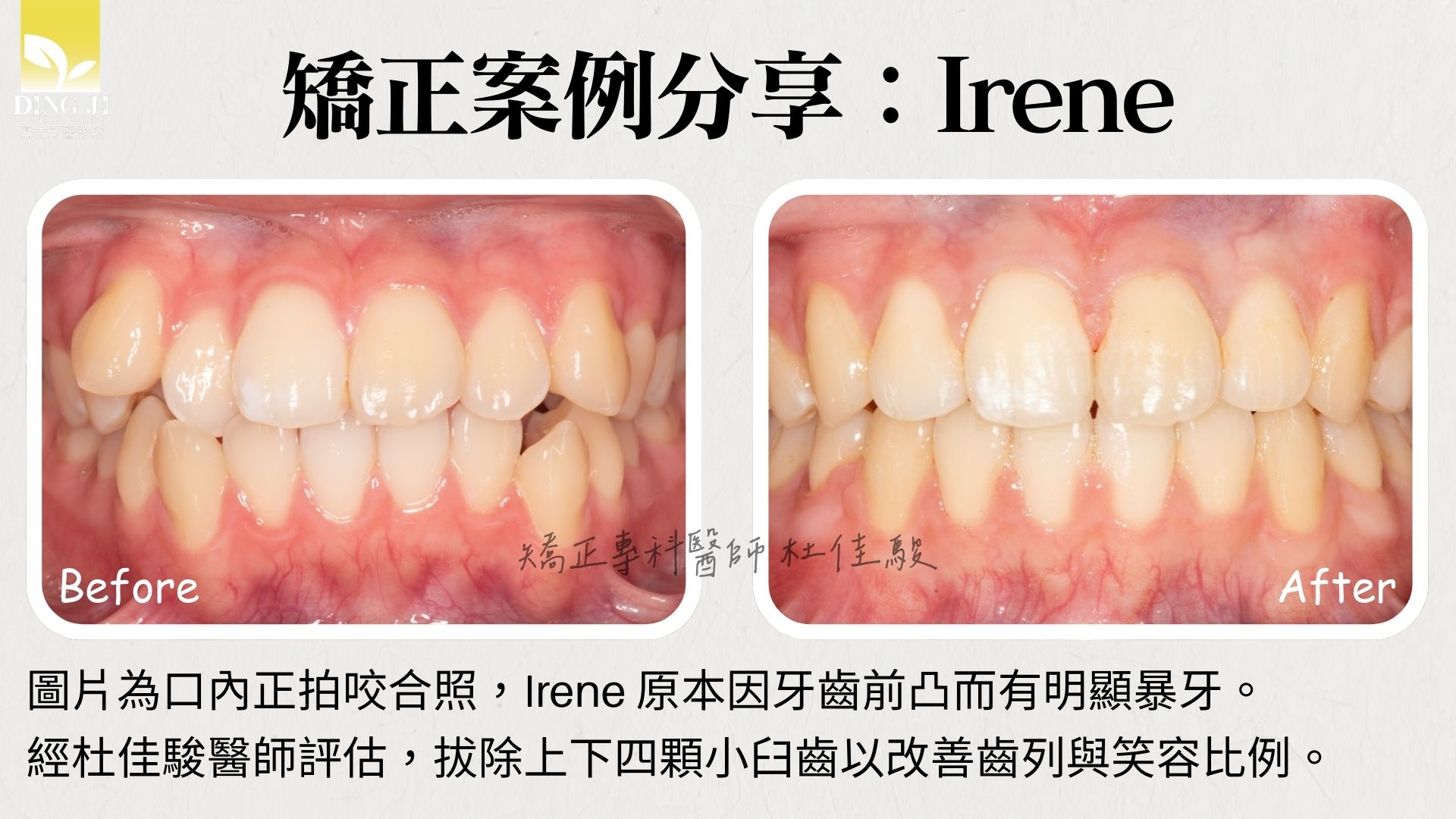 牙齒矯正前後對比