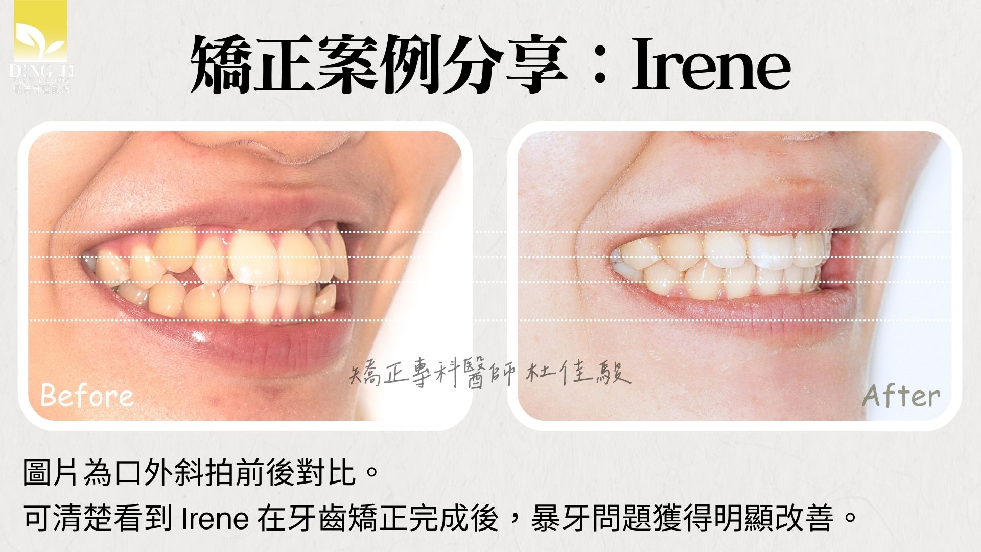 牙齒矯正拔四顆牙前後臉型對比