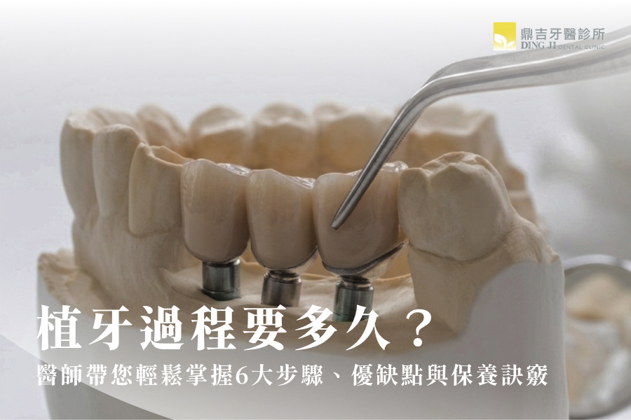 植牙過程要多久？醫師帶您輕鬆掌握6大步驟、優缺點與保養訣竅