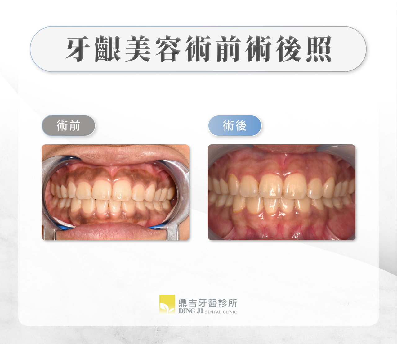 牙齦美容術前術後照
