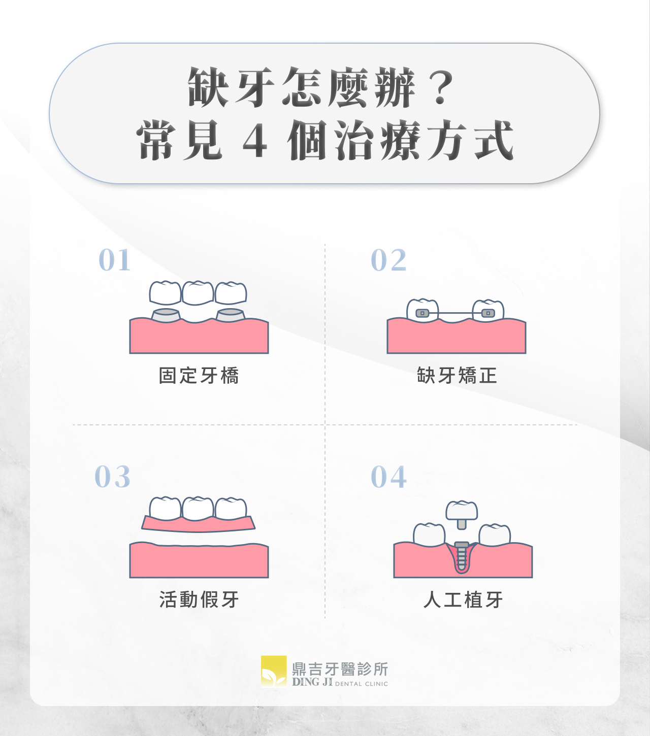缺牙怎麼辦?常見 4 個治療方式